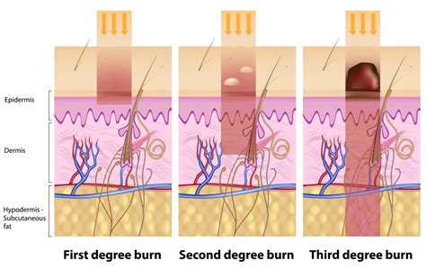 What is a Third-Degree Burn? (with pictures)