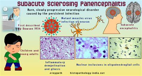 Pathology of Subacute Sclerosing Panencephalitis - Dr Sampurna Roy MD