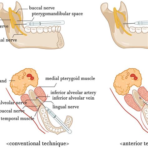 Inferior Alveolar Nerve Block Landmarks