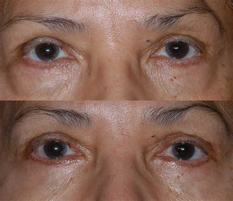 Lower Eyelid Surgery | Center for Excellence in Eye Care