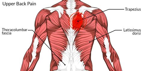 Upper Back Pain – The Complete Injury Guide - Vive Health