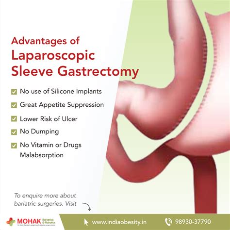 Advantages of Laparoscopic Sleeve Gastrectomy | Bariatric surgeon, Bariatric surgery