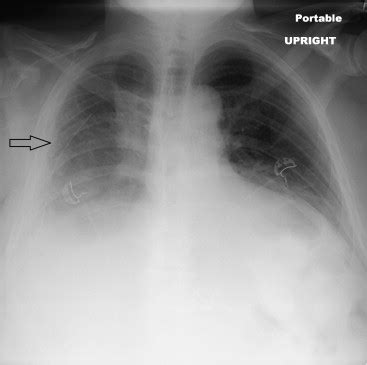 Interventional Radiologic Placement of Denver Pleuroperitoneal Shunt ...