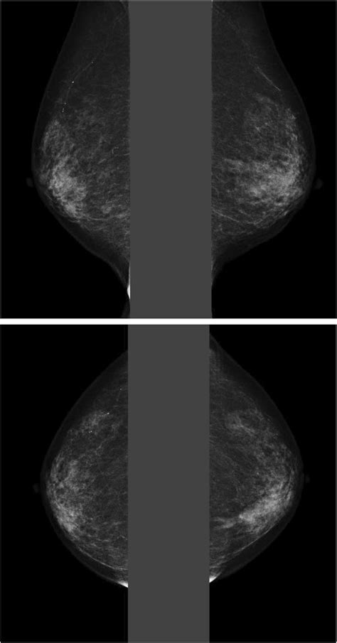 Mammogram findings. The bilateral craniocaudal view of the mammograms... | Download Scientific ...