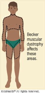 Becker Muscular Dystrophy | Dayton Children's Hospital