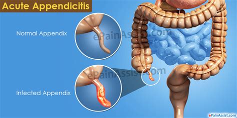 Acute Appendicitis|Causes|Signs|Symptoms|Treatment