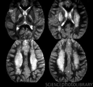 Acute Disseminated Encephalomyelitis - Prognosis, Symptoms