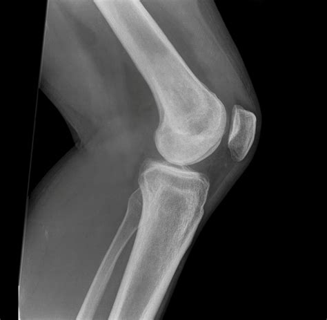 Anatomy of the Knee Joint (With Diagrams and X-Ray) - Owlcation