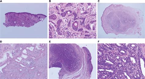 Dermal tumors with glandular differentiation. Notes: (A) Syringoma:... | Download Scientific Diagram