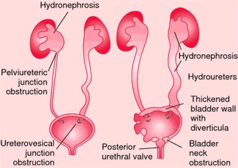 Hydronephrosis - Definition, What is, Symptoms, Treatment, Causes