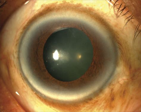 Effect of Corneal Arcus on Central Corneal Thickness, Intraocular ...