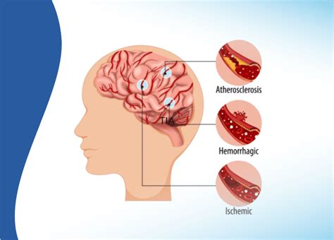 Brain Stroke: Warning Signs, Symptoms, and Prevention