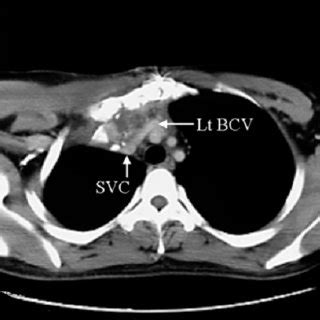 Preoperative CT: The SVC was depressed by the proximal side of the... | Download Scientific Diagram