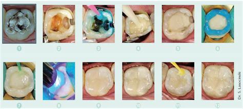 Dental materials: Glass Ionomer - Composite "sandwich" technique: when is the time to etch?