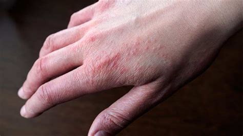 Psoriasis: Causes, Symptoms, Types & Treatment - Health Blog