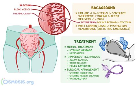 Uterine Atony: What Is It, Risk Factors, Treatment, and More | Osmosis