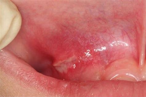 Canker Sores (Aphthous Ulcer) - Causes, Symptoms, Diagnosis | Cape ...