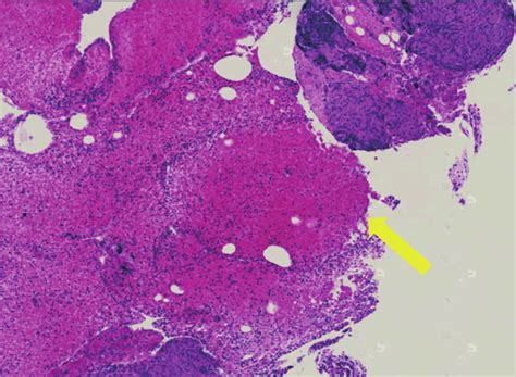 Histopathological slide of patient's pulmonary lymph node biopsy ...