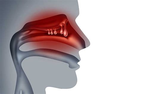 Nasal Polyps - OC ENT Clinic | Sinus Surgery | Septoplasty | Tonsillectomy | ENT Doctor