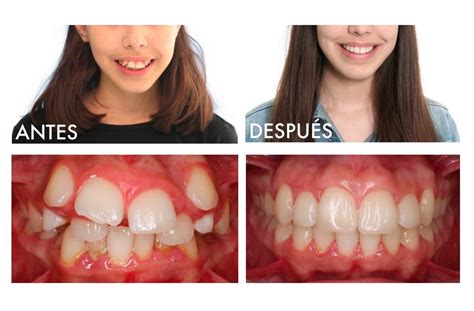 Ortodoncia (Antes y después) | Apiñamiento dental, Ortodoncia antes y ...