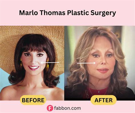 Marlo Thomas Plastic Surgery Secrets: Before And After Photos | Fabbon