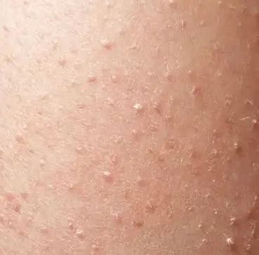 white-spots-on-skin.png – BeautyClue