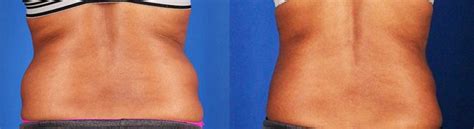 CoolSculpting Before and After Photos | Contour Dermatology