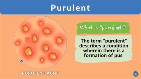 Purulent - Definition and Examples - Biology Online Dictionary