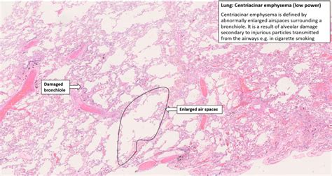 Lung – Emphysema – NUS Pathweb :: NUS Pathweb