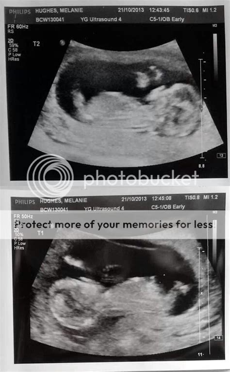 Twins or more Scan Photos - BabyCentre