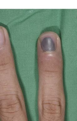 3: Nail Bed Repair | Plastic Surgery Key