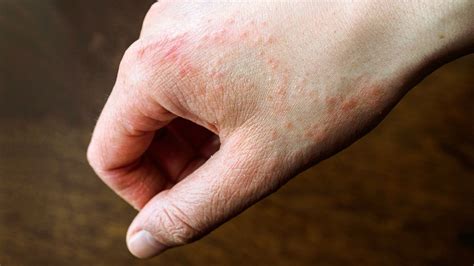 Itchy Red Rash On Hands And Feet : Foot Rash Causes Symptoms And Treatments / They are ...