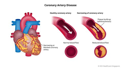 Coronary Artery Disease (CAD) - Causes and Symptoms | Parkway East Hospital
