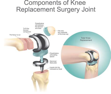 Knee Replacement Surgery (Total Knee Arthroplasty) - Schulze Orthopedics