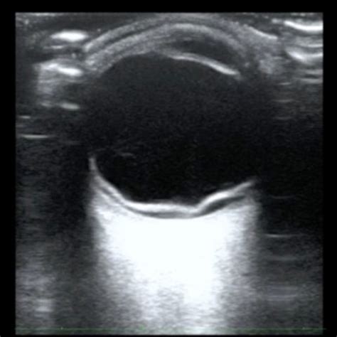 Retinal Detachment, Ultrasound Still. JETem 2018 - JETem