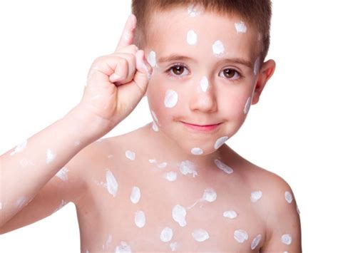 How To Treat Chickenpox Scars? | Healthy Living