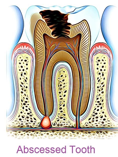 Toothache Causes and Pain Relief Treatments – Archer Dental