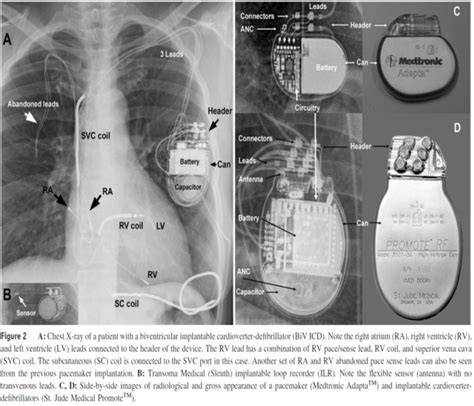 Pacemaker Identification X Ray