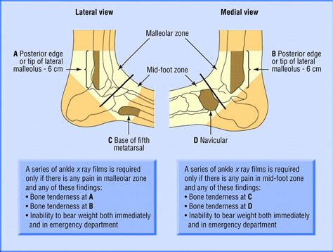 Sprained ankle explained