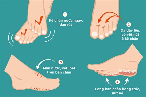 Chữa nấm da chân đúng cách giúp bệnh nhanh khỏi