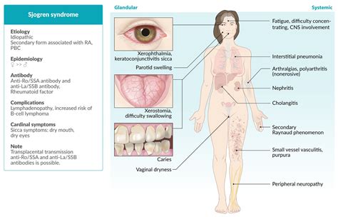 Sjogrens Syndrome Dry Eye Lymph Nodes Stock Vector (Royalty, 55% OFF