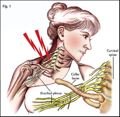 Nerve Injury