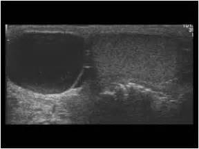 Epididymal Cyst