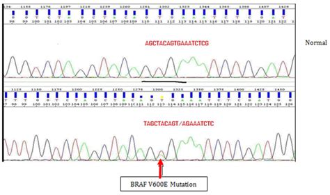 BRAF V600E mutation in hairy cell leukaemia a single center descriptive cross sectional study ...