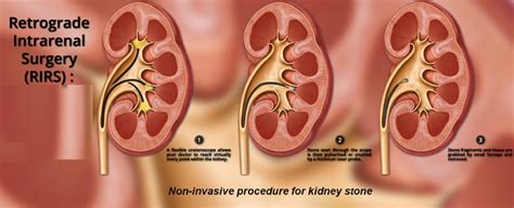 Retrograde Intrarenal Surgery (RIRS) - Dr. Hiralal Chaudhari