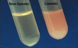 Pseudohyponatremia - Renal Fellow Network