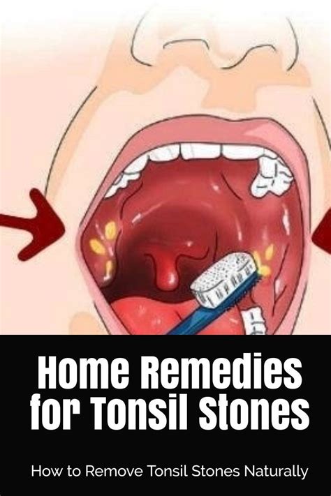 How To Remove Tonsil Stones Home Remedies - HOWOTREMVO