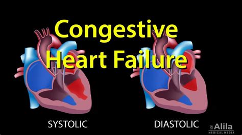 Heart Left Or Right - Hypoplasia of the Right Ventricle | Radiology Key ...