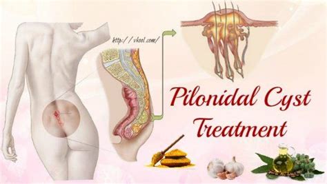 16 Tips Of Natural Pilonidal Cyst Treatment You Should Know