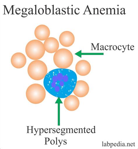 Anemia – Part 4 – Megaloblastic Anemias, Macrocytic, and Lab findings ...